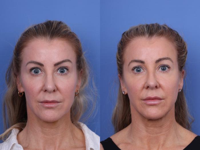 Before & After Rhinoplasty Case 698 Front View in Scottsdale, AZ