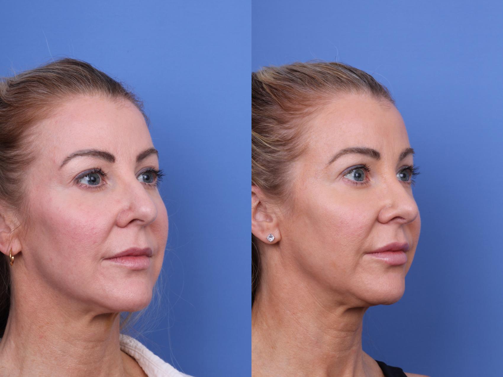 Before & After Rhinoplasty Case 698 Right Oblique View in Scottsdale, AZ
