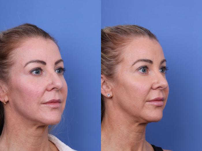 Before & After Rhinoplasty Case 698 Right Oblique View in Scottsdale, AZ