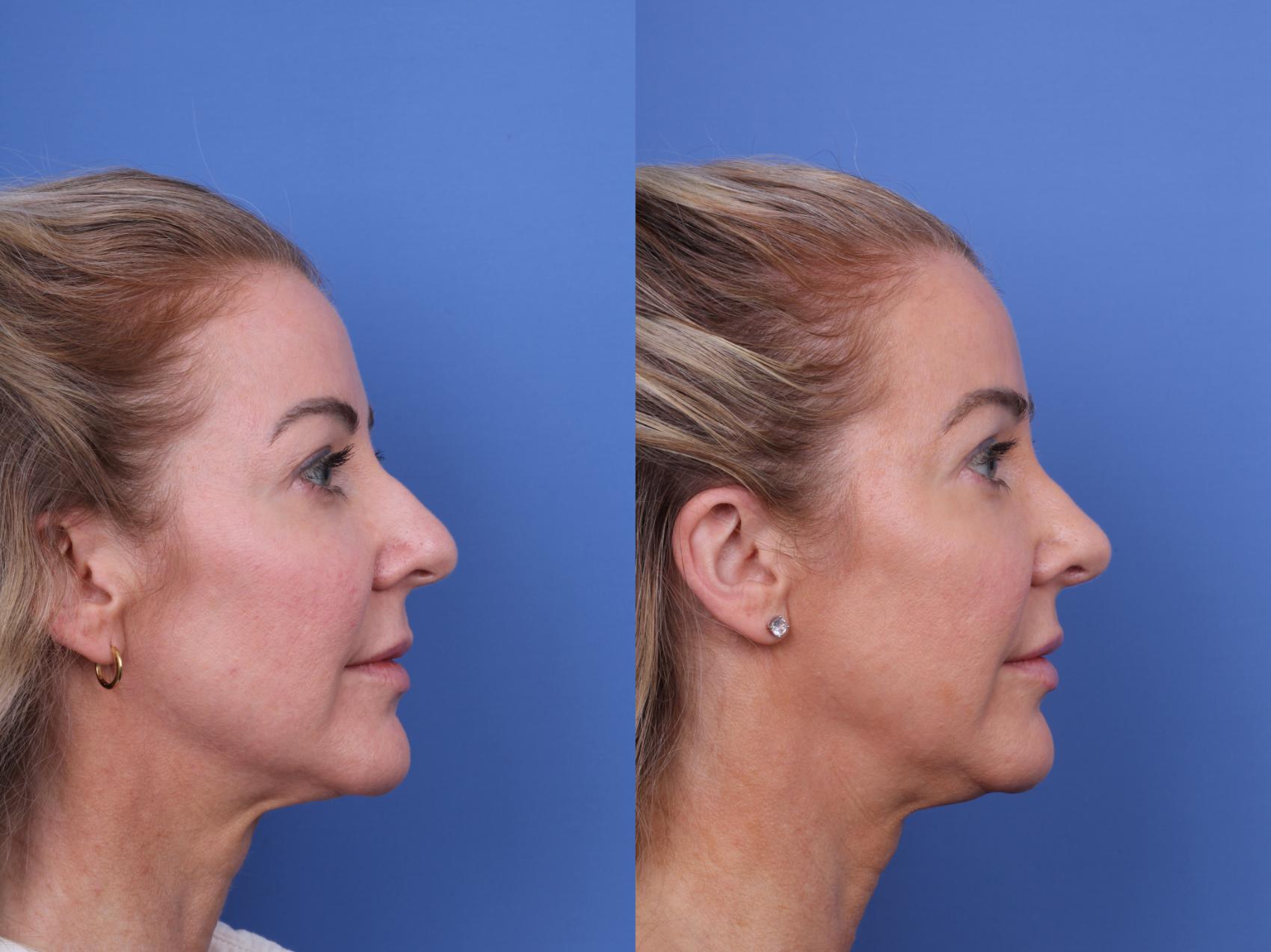 Before & After Rhinoplasty Case 698 Right Side View in Scottsdale, AZ