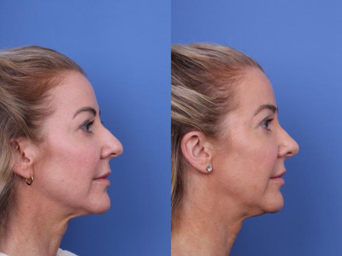 Before & After Rhinoplasty Case 698 Right Side View in Scottsdale, AZ