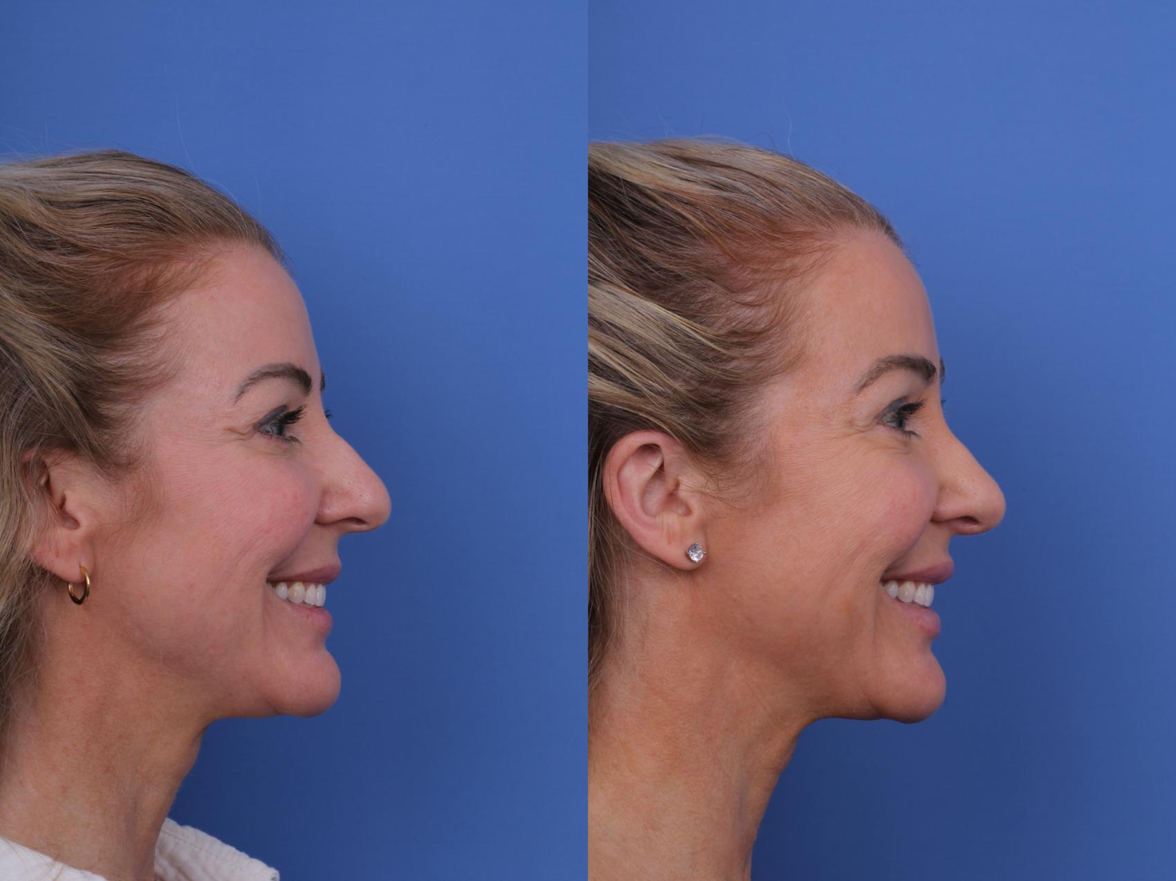 Before & After Rhinoplasty Case 698 Right Smile View in Scottsdale, AZ
