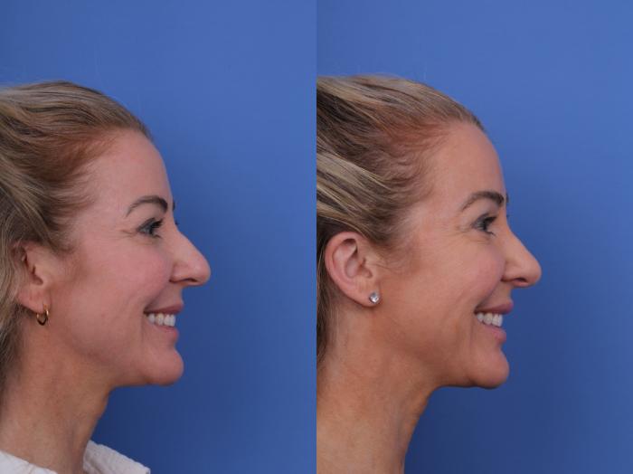 Before & After Rhinoplasty Case 698 Right Smile View in Scottsdale, AZ