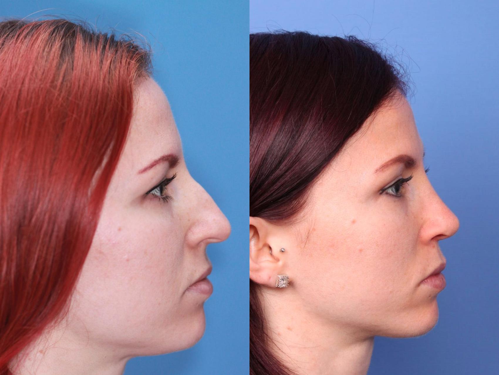 Before & After Rhinoplasty Case 7 View #2 View in Scottsdale, AZ