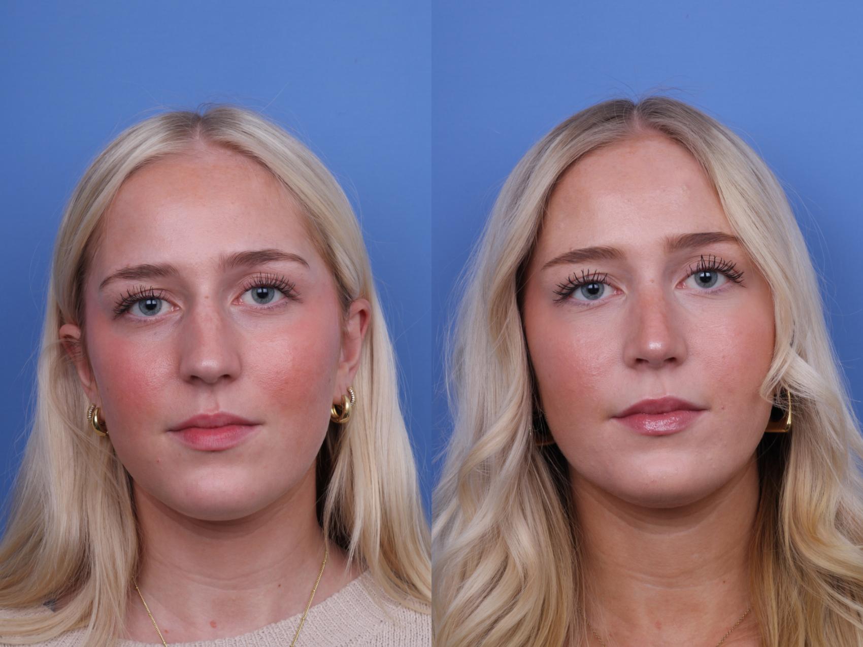 Before & After Rhinoplasty Case 700 Front View in Scottsdale, AZ