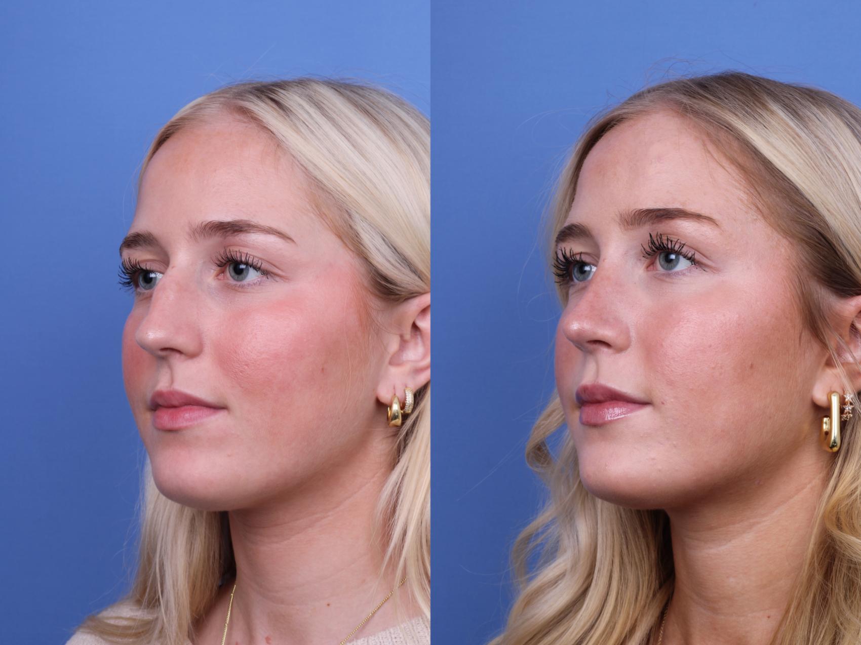 Before & After Rhinoplasty Case 700 Left Oblique View in Scottsdale, AZ