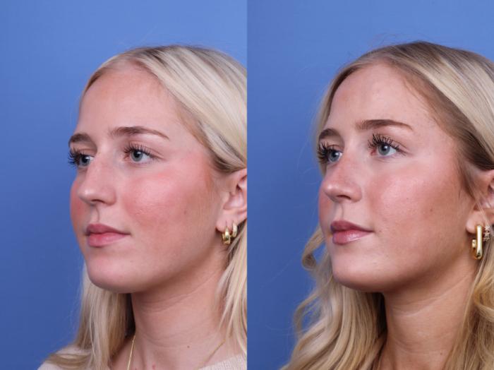 Before & After Rhinoplasty Case 700 Left Oblique View in Scottsdale, AZ