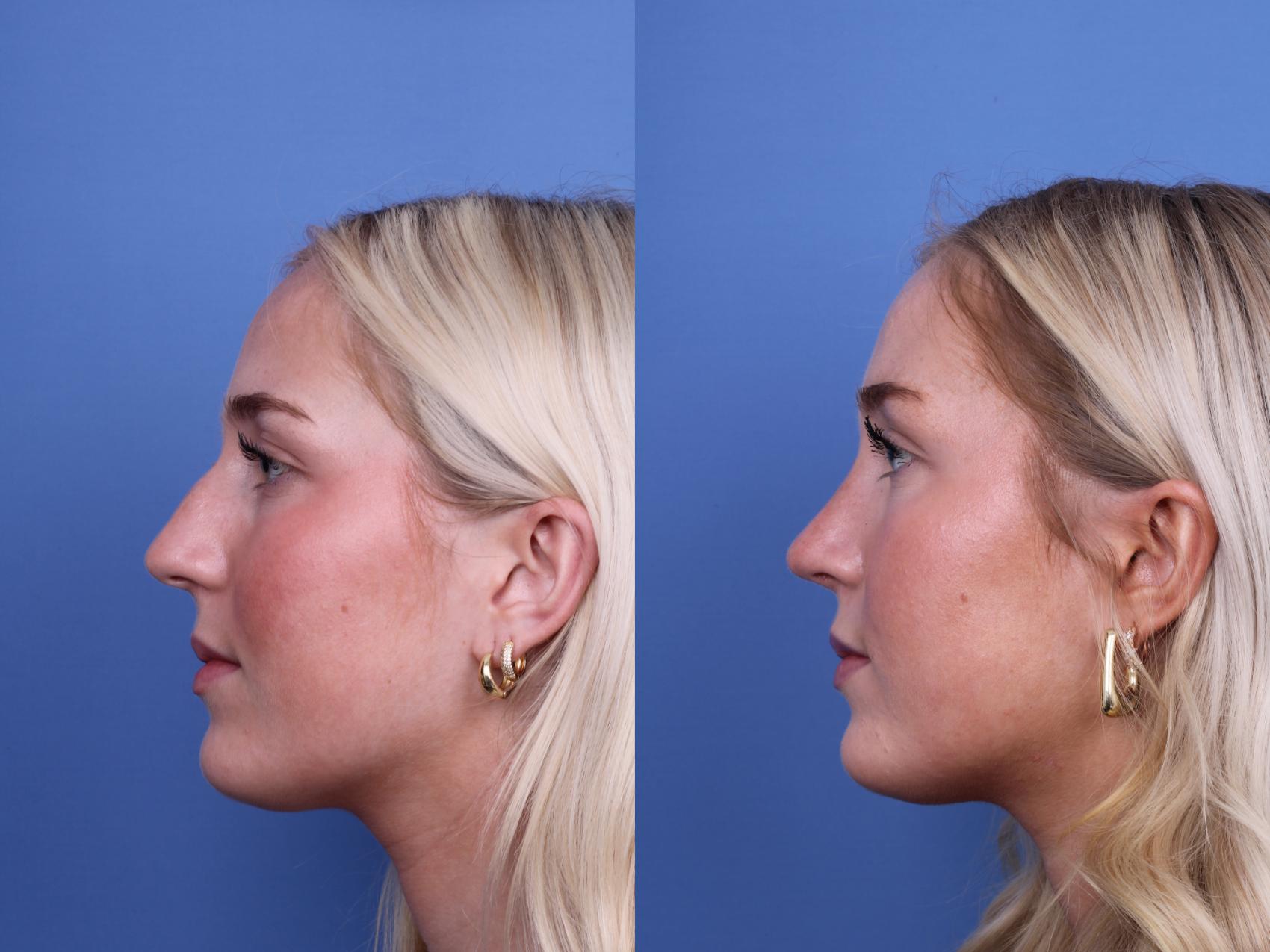 Before & After Rhinoplasty Case 700 Left Side View in Scottsdale, AZ