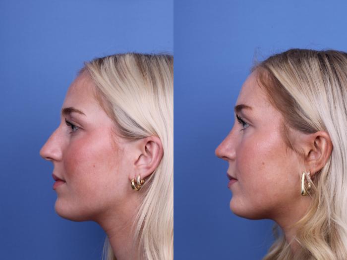 Before & After Rhinoplasty Case 700 Left Side View in Scottsdale, AZ