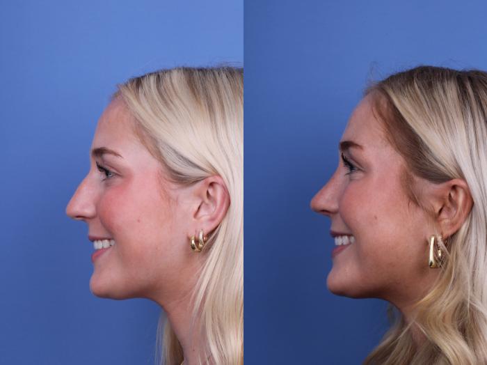 Before & After Rhinoplasty Case 700 Left Smile View in Scottsdale, AZ