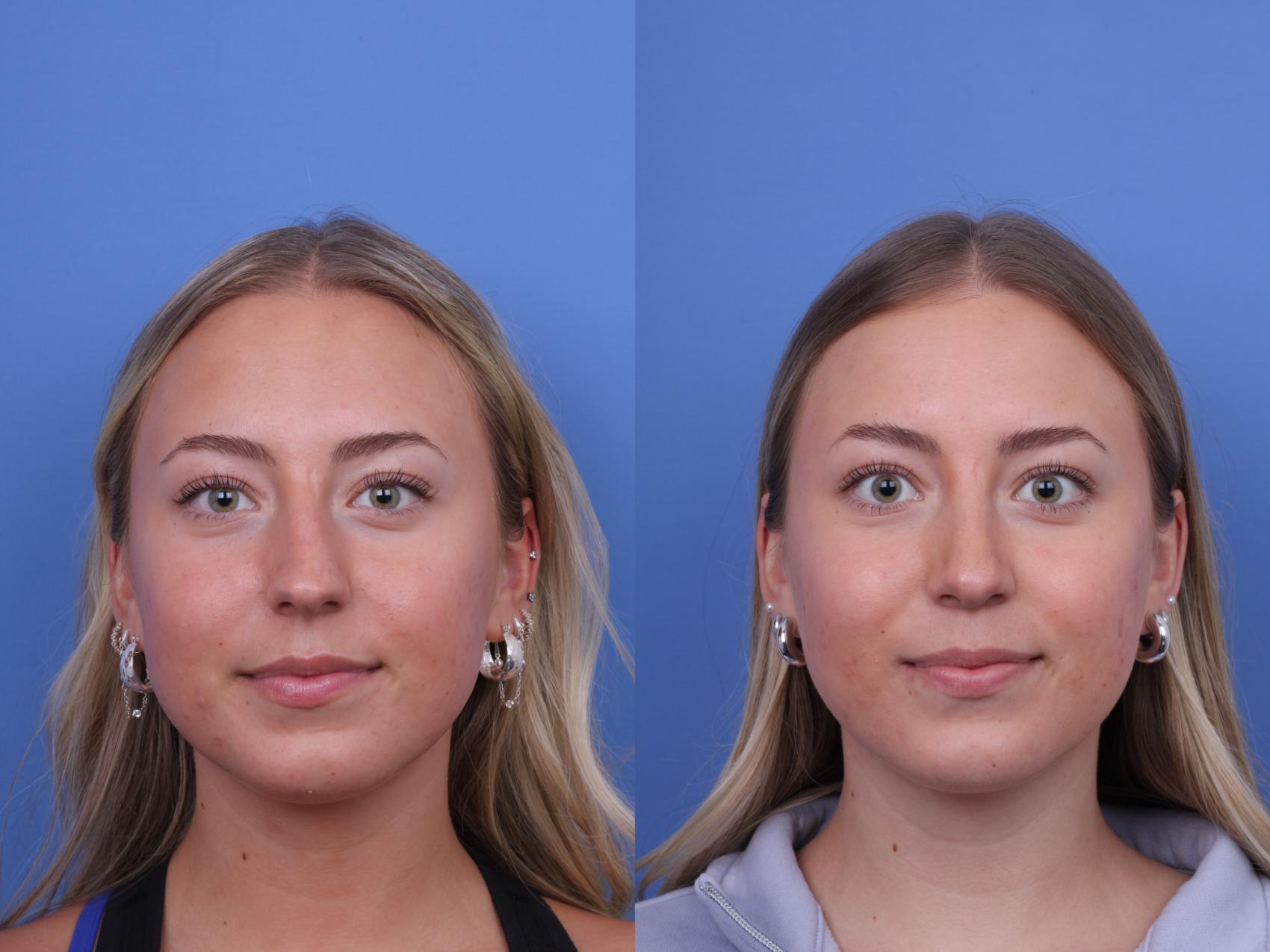 Before & After Rhinoplasty Case 701 Front View in Scottsdale, AZ