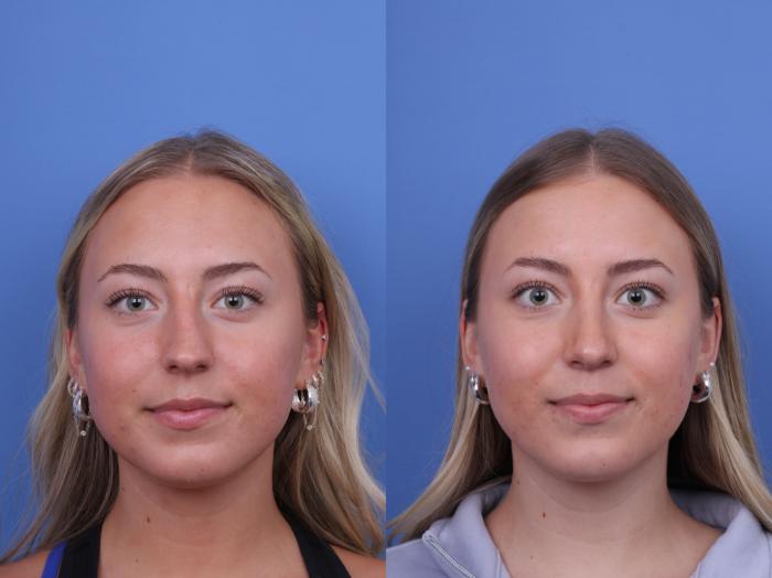Before & After Rhinoplasty Case 701 Front View in Scottsdale, AZ