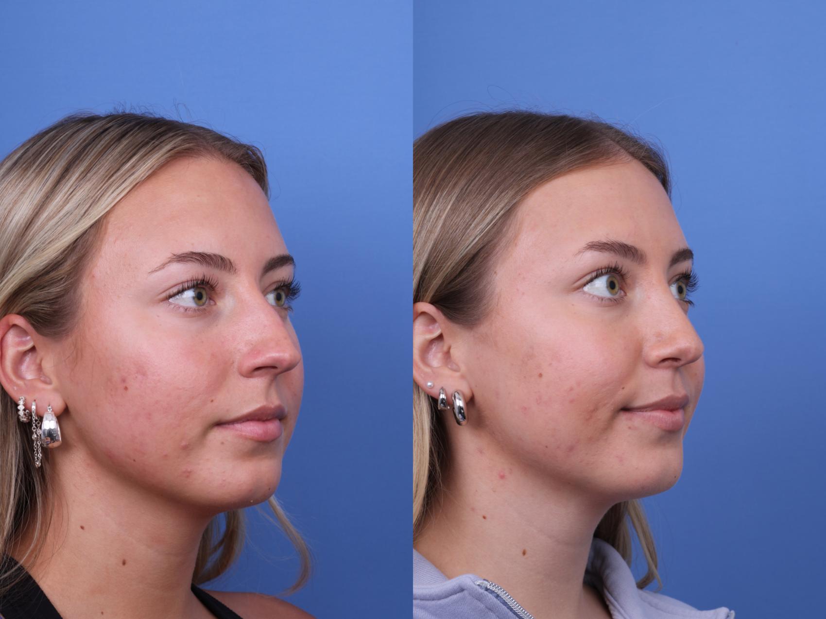 Before & After Rhinoplasty Case 701 Right Oblique View in Scottsdale, AZ
