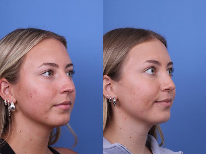 Before & After Rhinoplasty Case 701 Right Oblique View in Scottsdale, AZ
