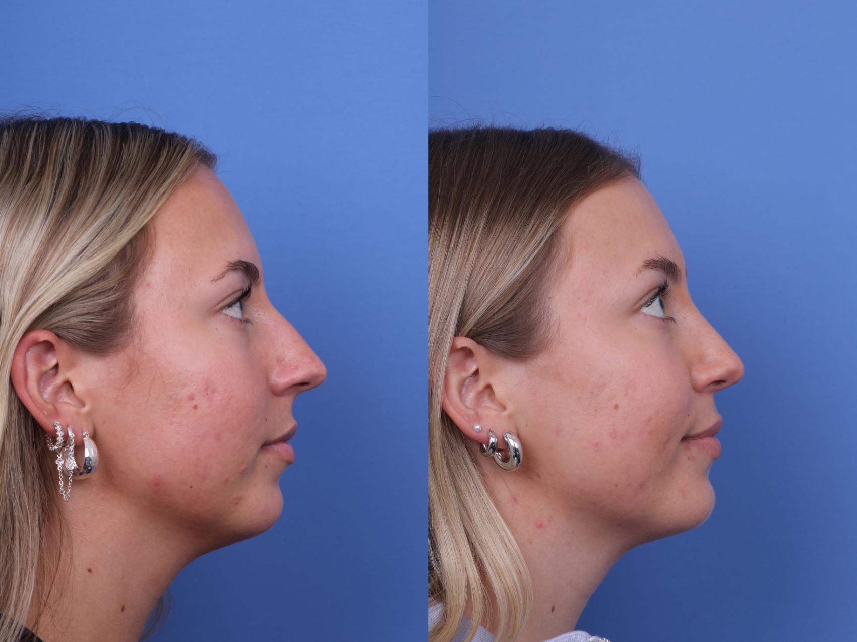 Before & After Rhinoplasty Case 701 Right Side View in Scottsdale, AZ
