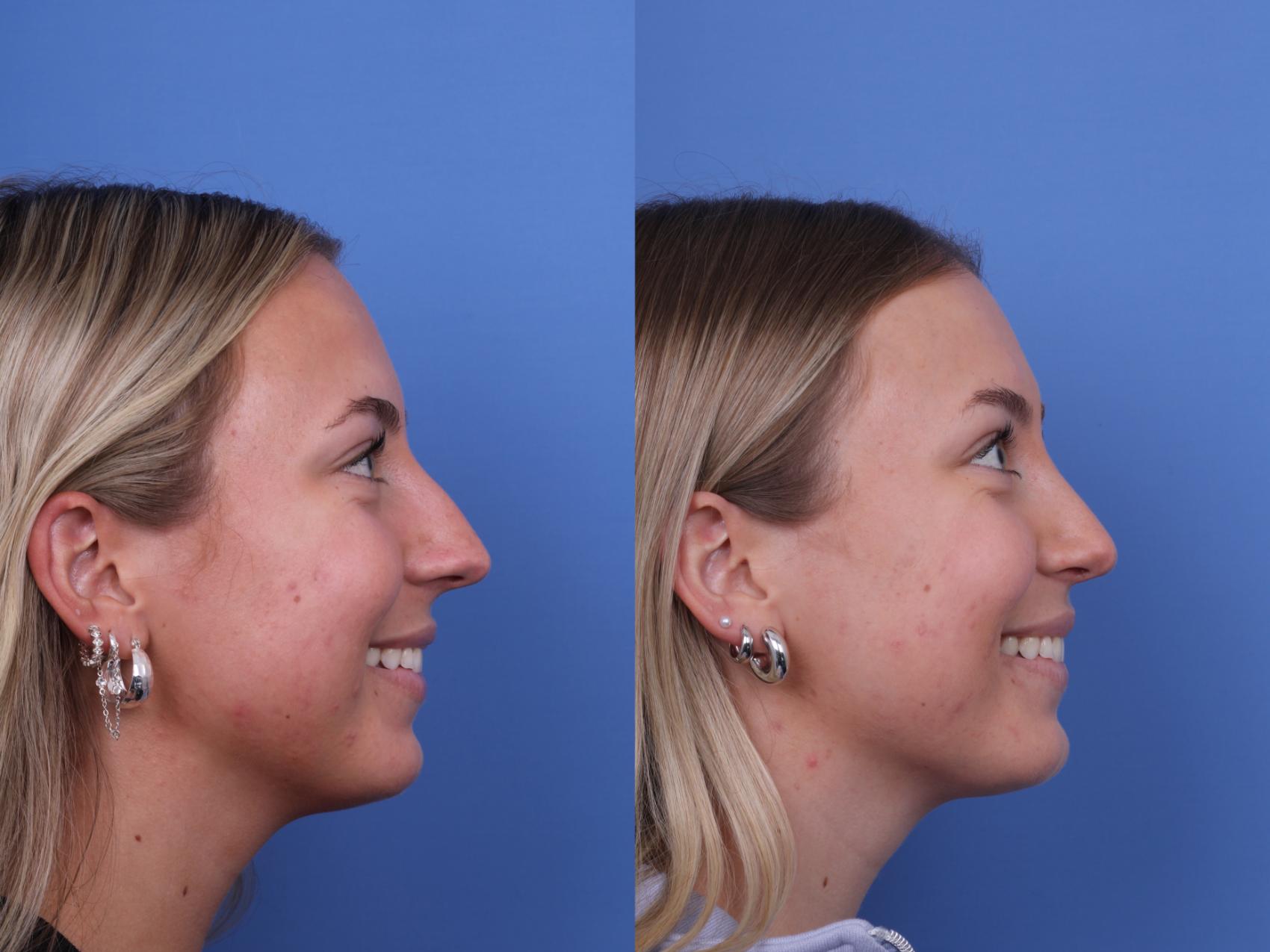 Before & After Rhinoplasty Case 701 Right Smile View in Scottsdale, AZ