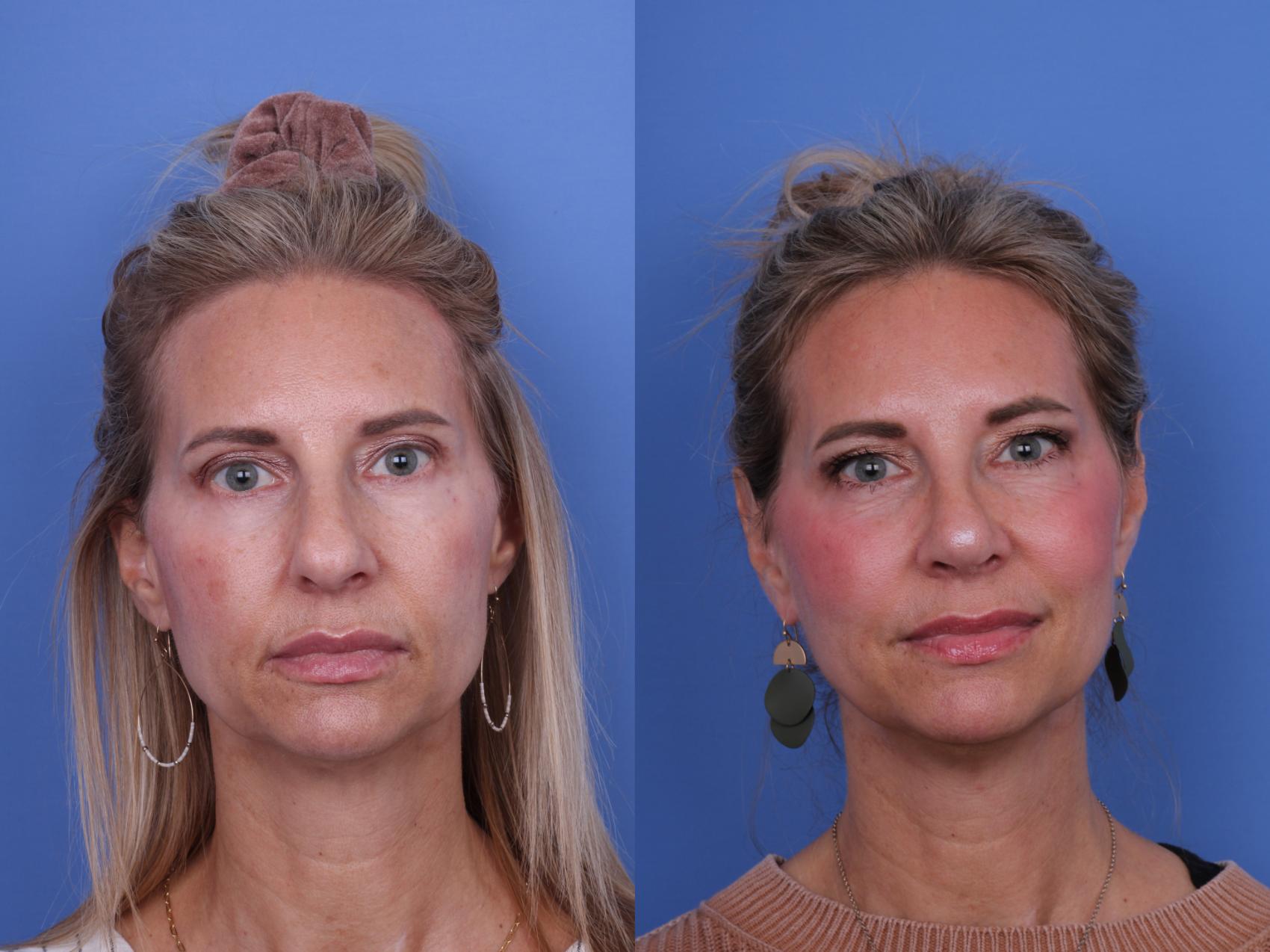 Before & After Rhinoplasty Case 703 Front View in Scottsdale, AZ