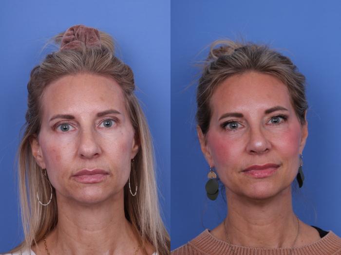 Before & After Rhinoplasty Case 703 Front View in Scottsdale, AZ