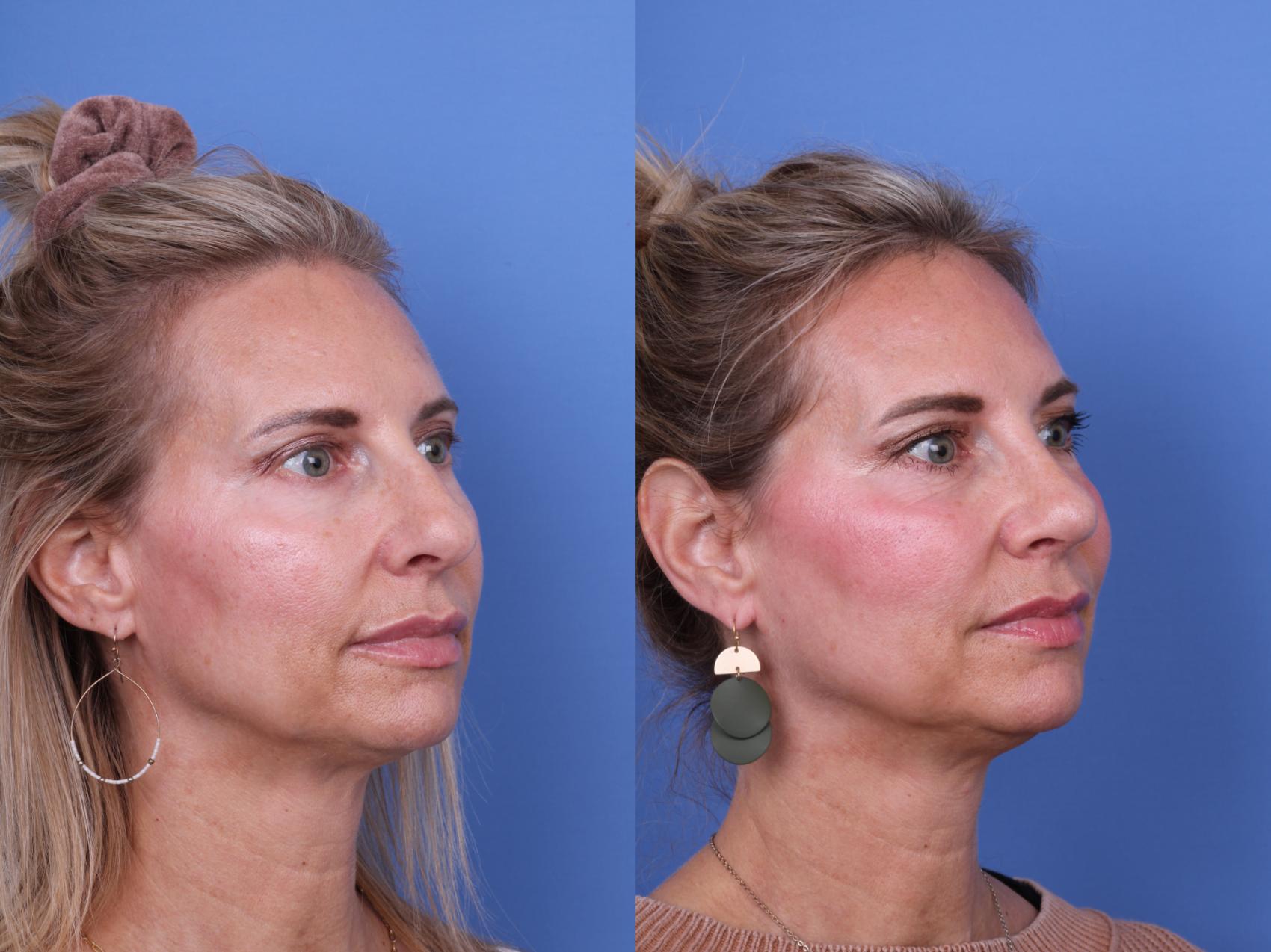 Before & After Rhinoplasty Case 703 Right Oblique View in Scottsdale, AZ