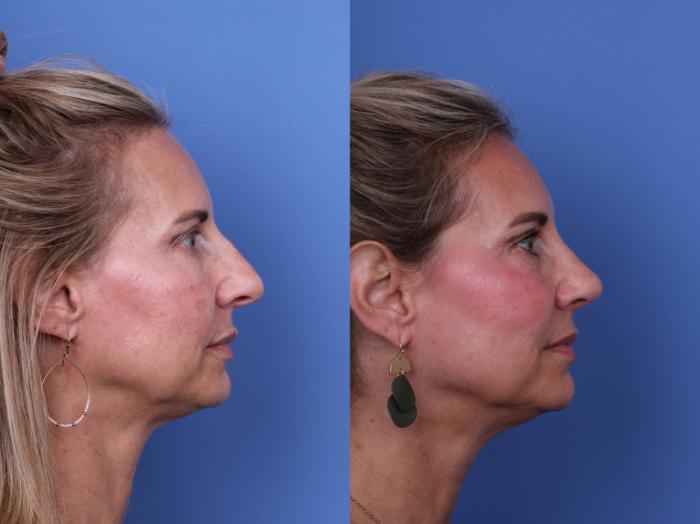 Before & After Rhinoplasty Case 703 Right Side View in Scottsdale, AZ