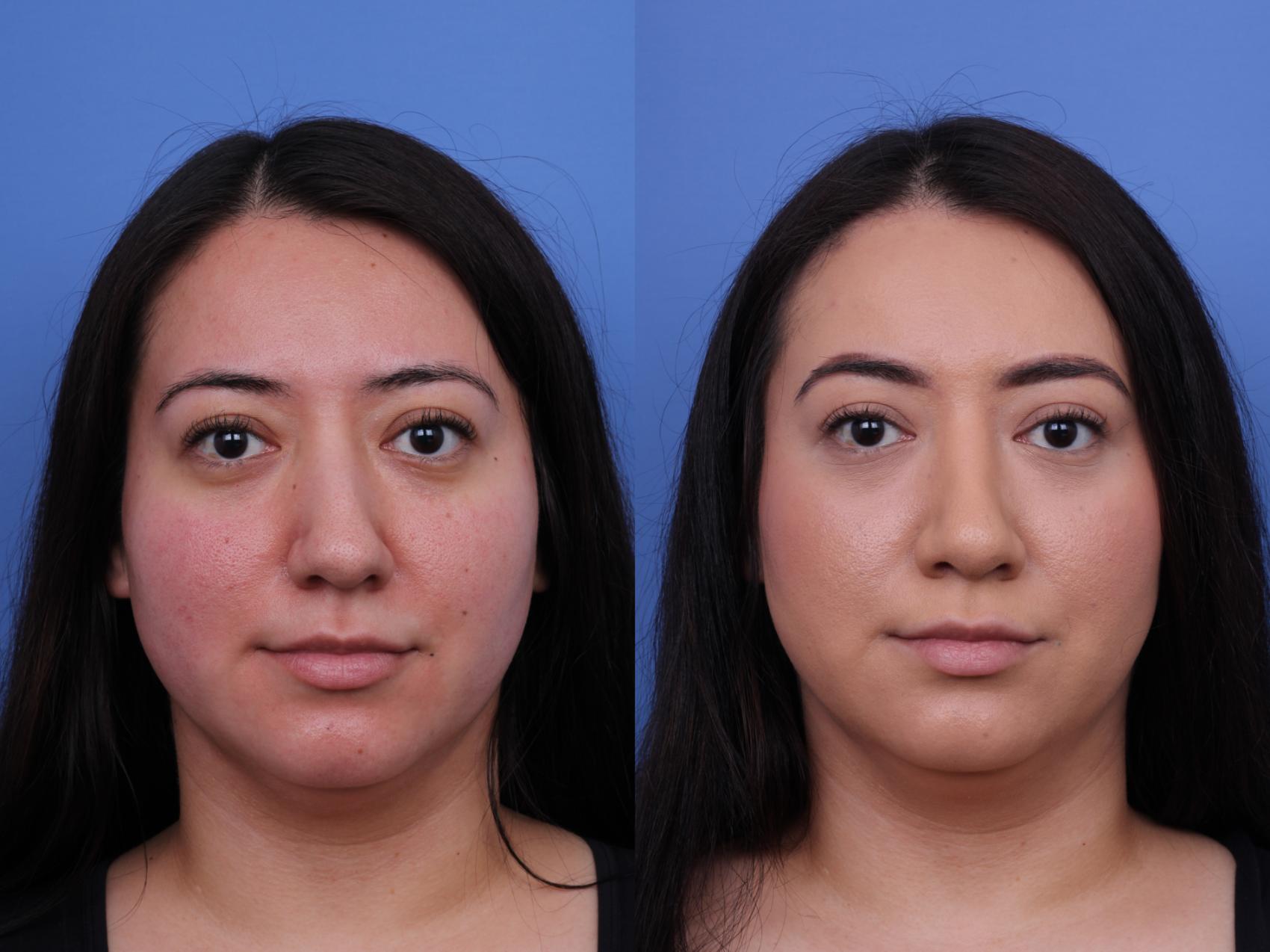 Before & After Rhinoplasty Case 706 Front View in Scottsdale, AZ