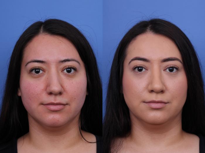 Before & After Rhinoplasty Case 706 Front View in Scottsdale, AZ