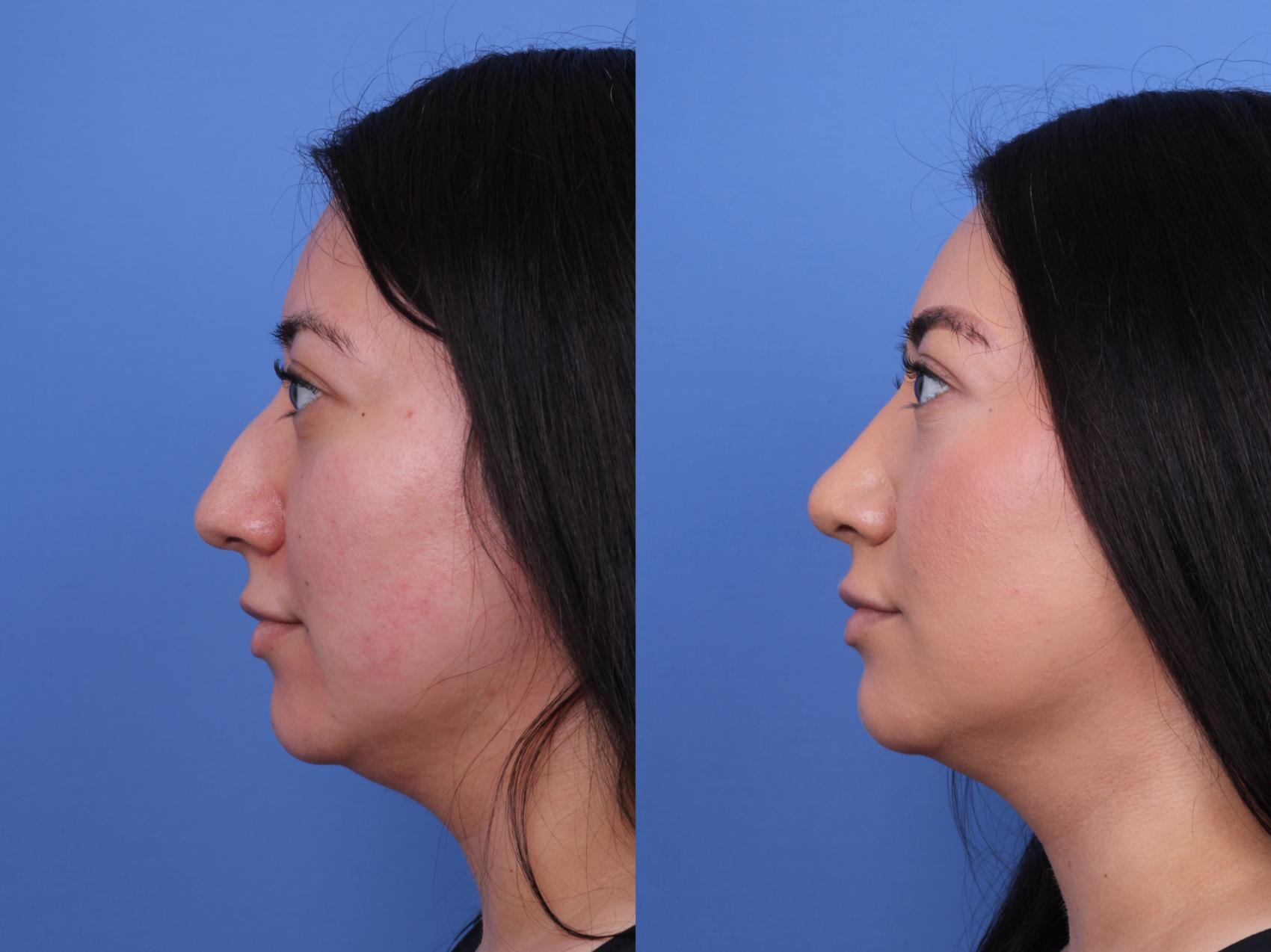 Before & After Rhinoplasty Case 706 Left Side View in Scottsdale, AZ