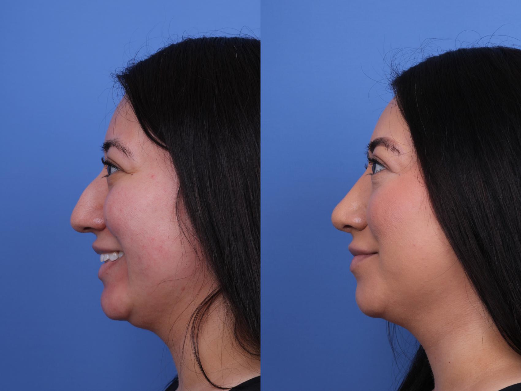 Before & After Rhinoplasty Case 706 Left Smile View in Scottsdale, AZ