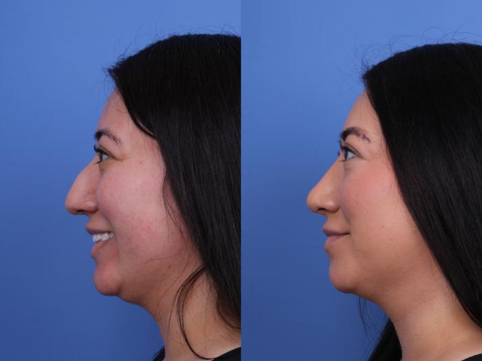 Before & After Rhinoplasty Case 706 Left Smile View in Scottsdale, AZ