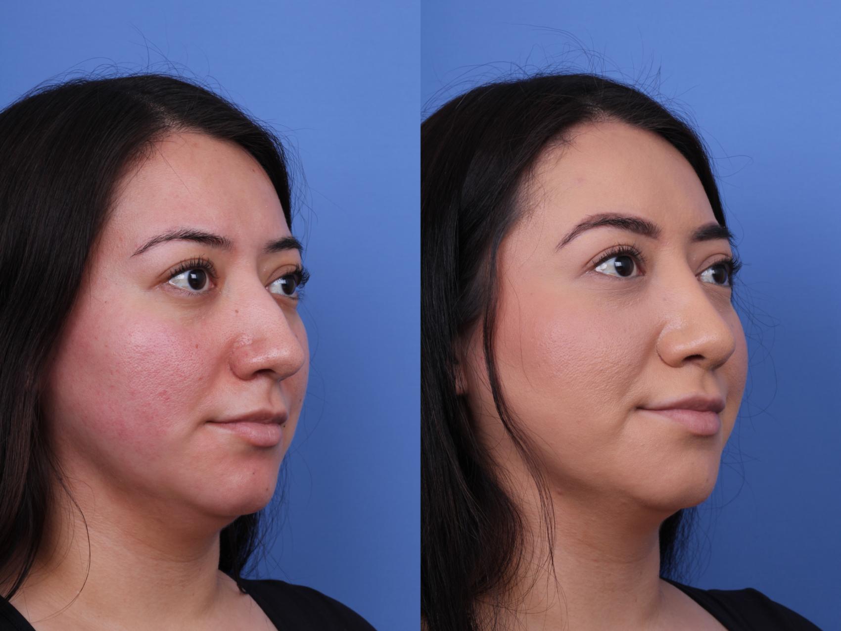 Before & After Rhinoplasty Case 706 Right Oblique View in Scottsdale, AZ