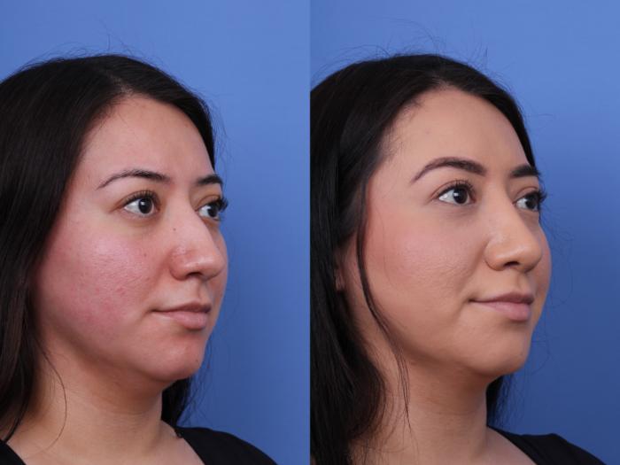 Before & After Rhinoplasty Case 706 Right Oblique View in Scottsdale, AZ