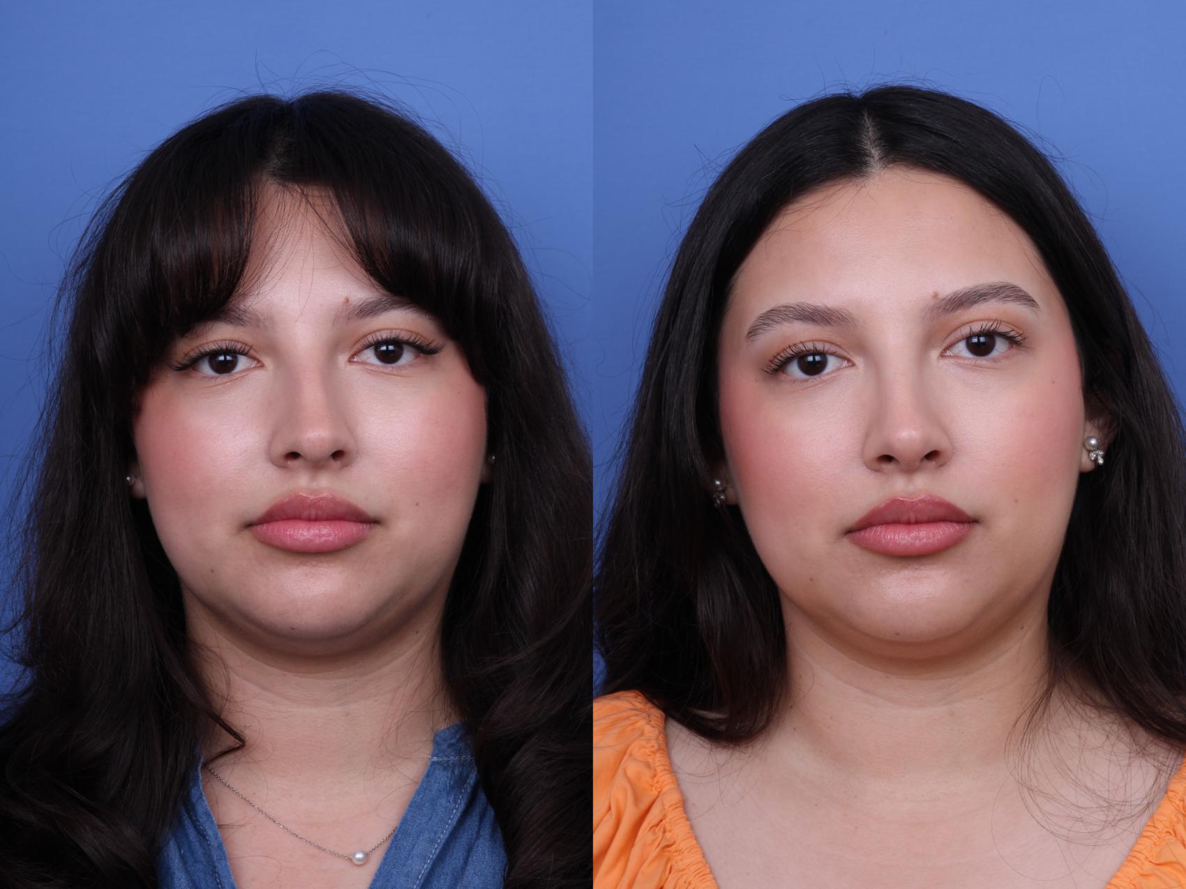 Before & After Rhinoplasty Case 707 Front View in Scottsdale, AZ