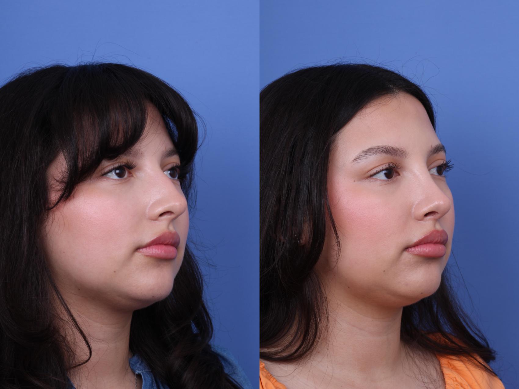 Before & After Rhinoplasty Case 707 Right Oblique View in Scottsdale, AZ