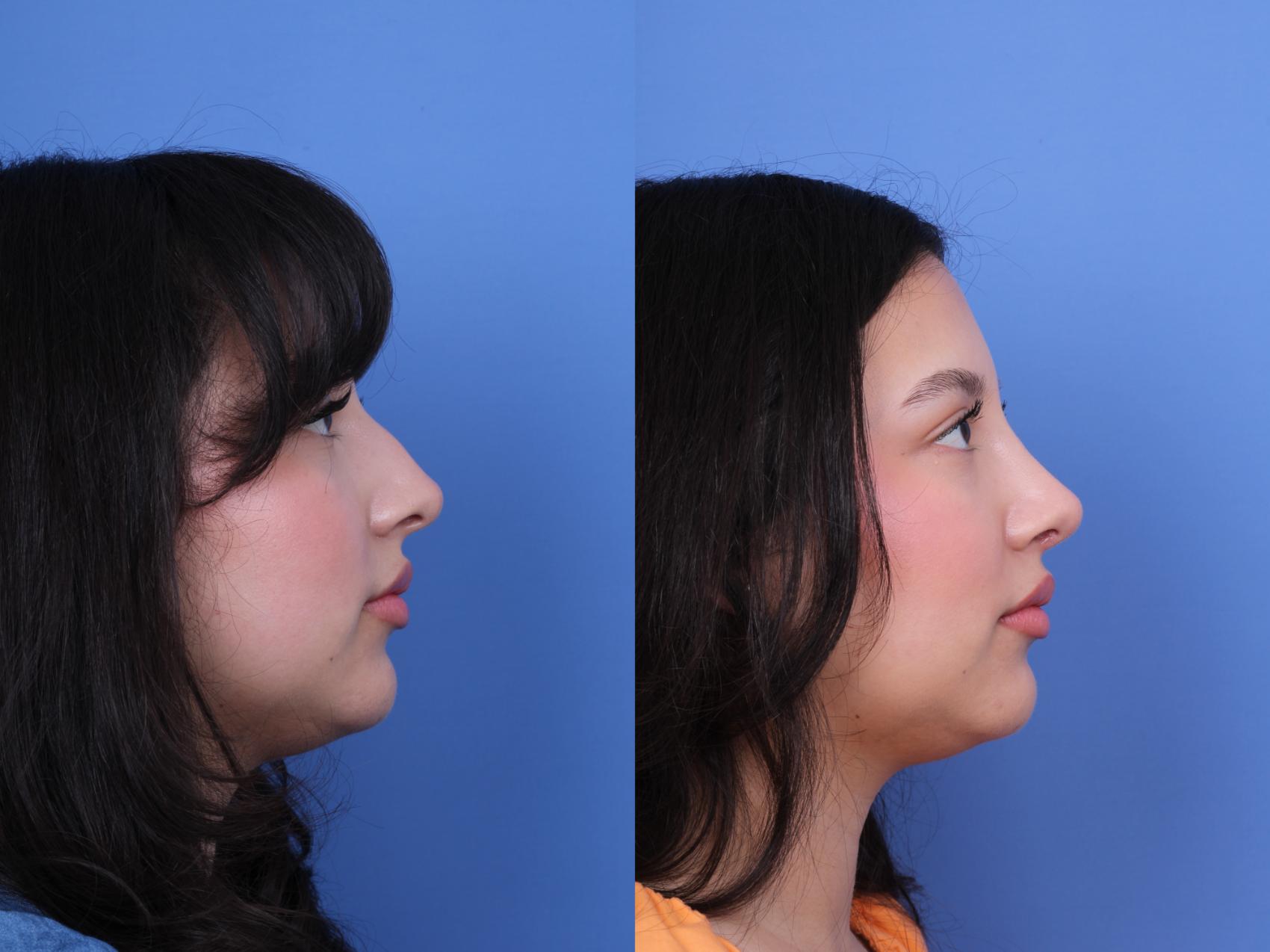 Before & After Rhinoplasty Case 707 Right Side View in Scottsdale, AZ