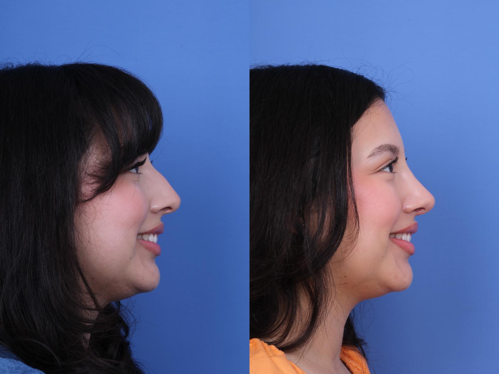 Before & After Rhinoplasty Case 707 Right Smile View in Scottsdale, AZ