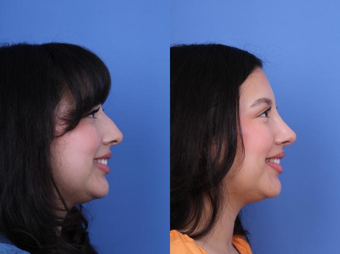 Before & After Rhinoplasty Case 707 Right Smile View in Scottsdale, AZ