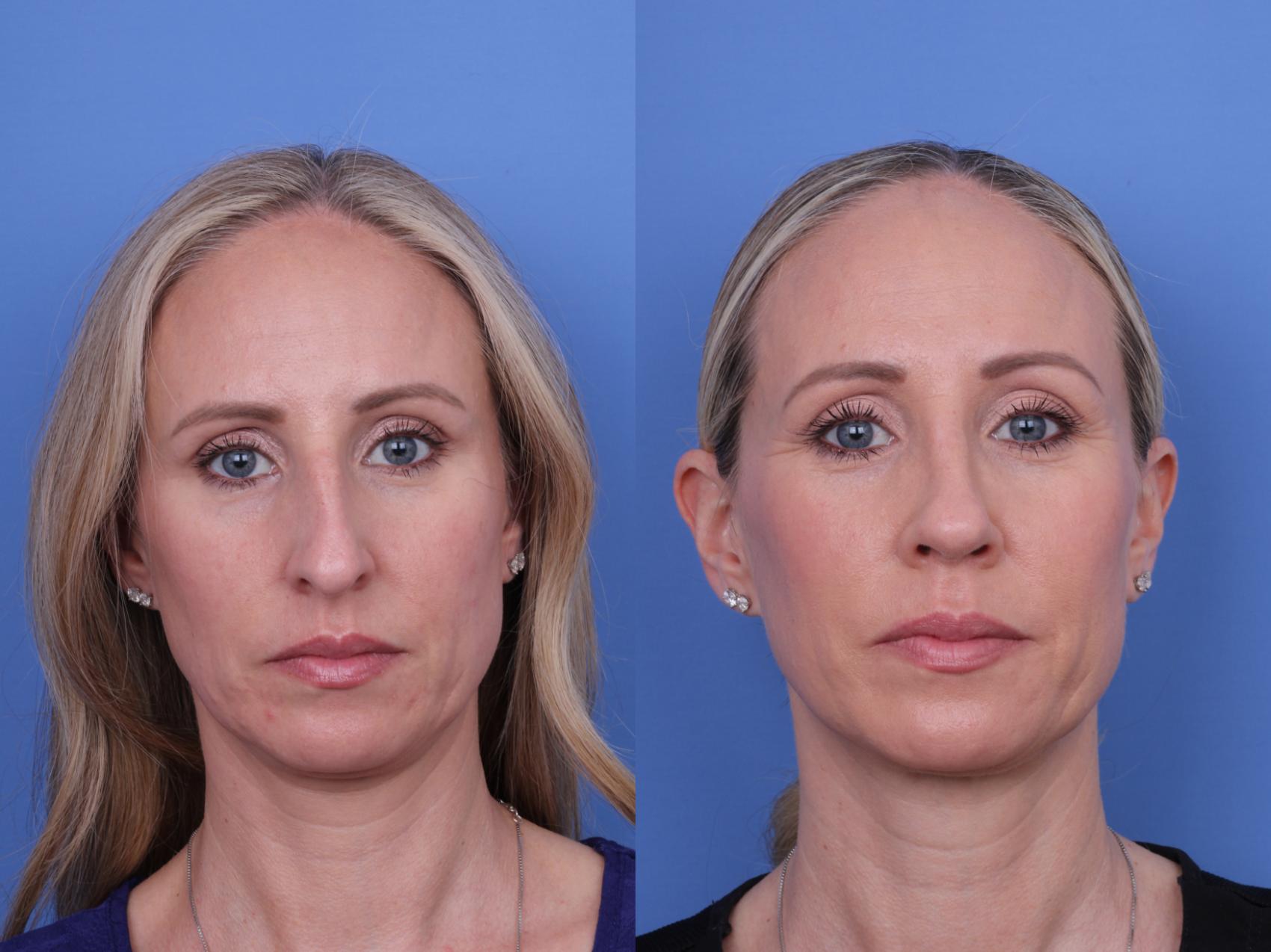 Before & After Rhinoplasty Case 708 Front View in Scottsdale, AZ