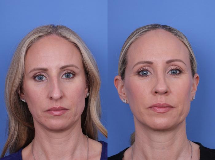 Before & After Rhinoplasty Case 708 Front View in Scottsdale, AZ