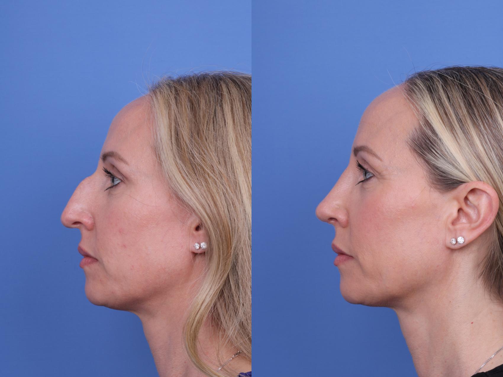 Before & After Rhinoplasty Case 708 Left Side View in Scottsdale, AZ