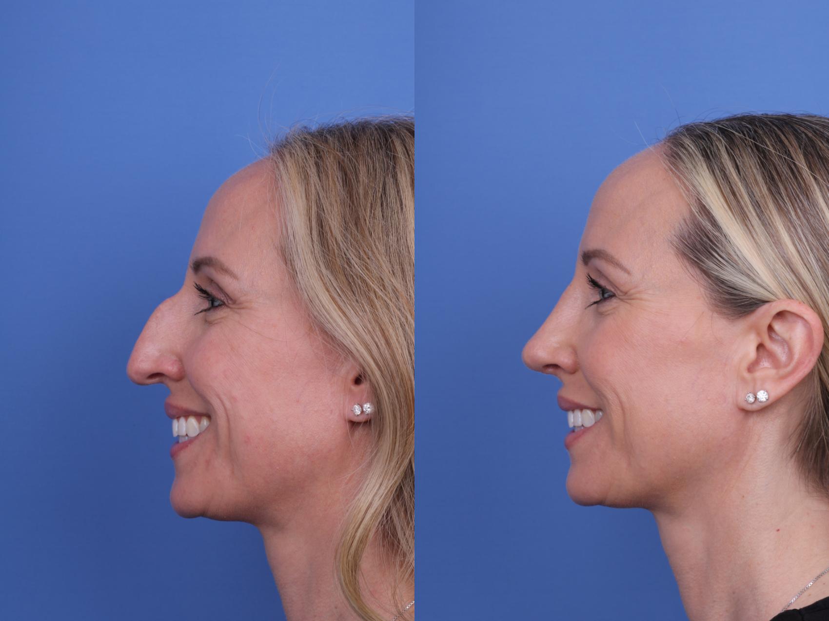 Before & After Rhinoplasty Case 708 Left Smile View in Scottsdale, AZ