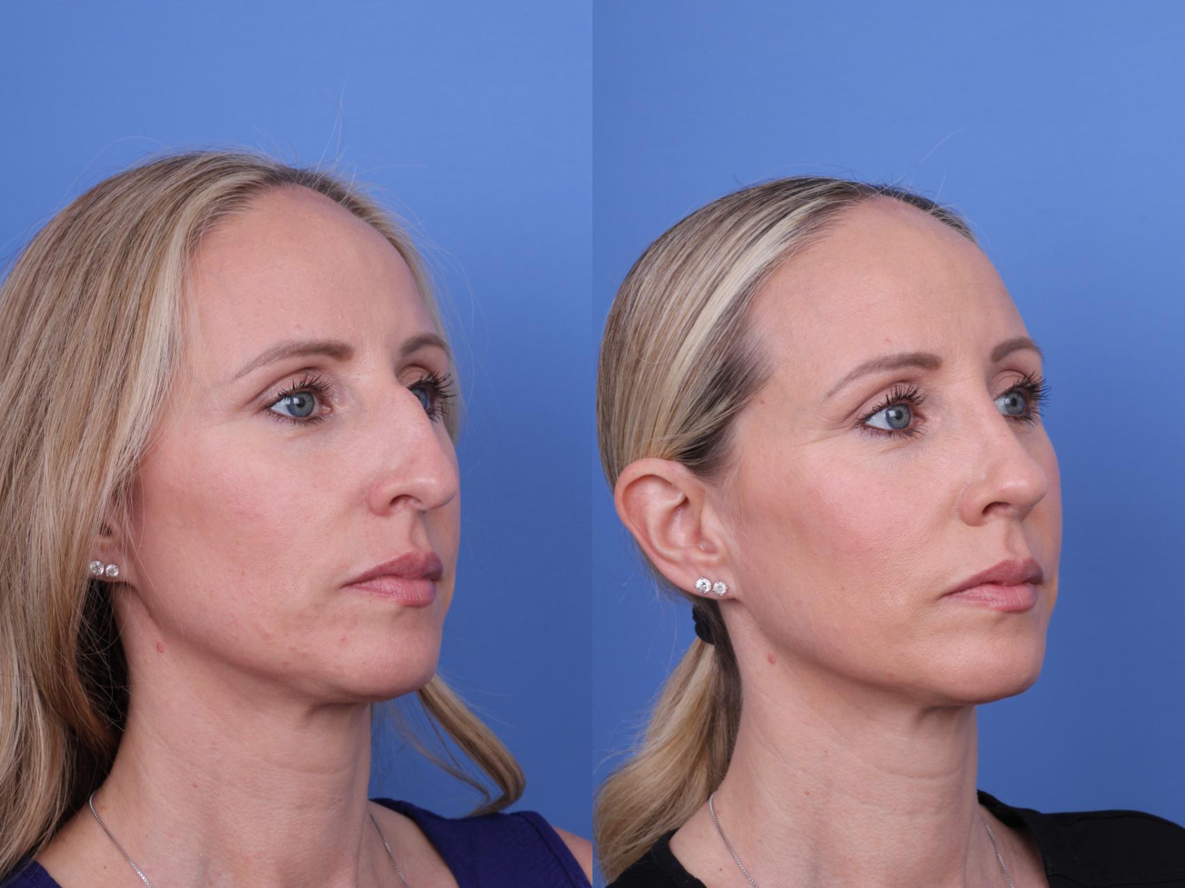 Before & After Rhinoplasty Case 708 Right Oblique View in Scottsdale, AZ