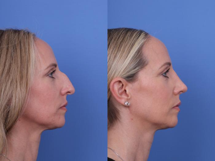Before & After Rhinoplasty Case 708 Right Side View in Scottsdale, AZ
