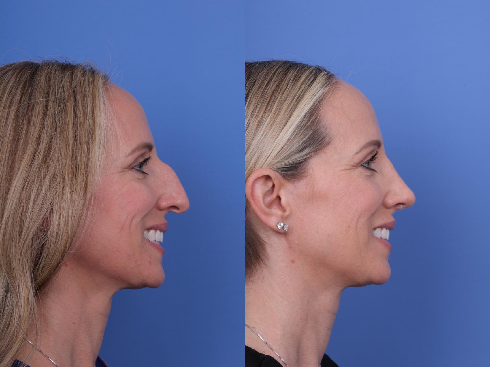 Before & After Rhinoplasty Case 708 Right Smile View in Scottsdale, AZ