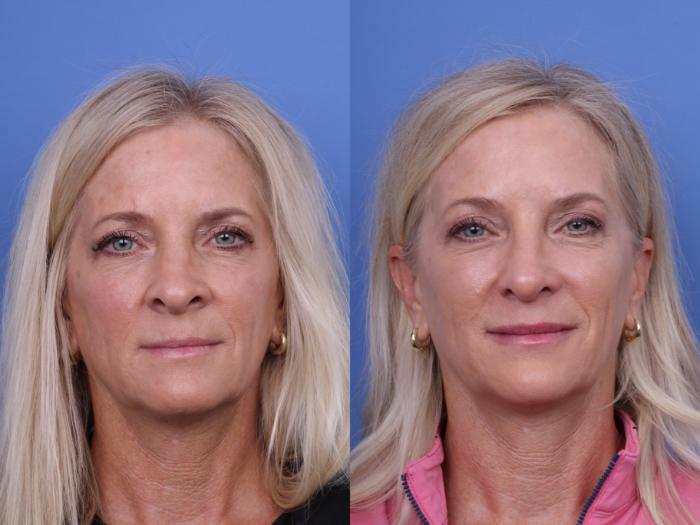 Before & After Rhinoplasty Case 713 Front View in Scottsdale, AZ