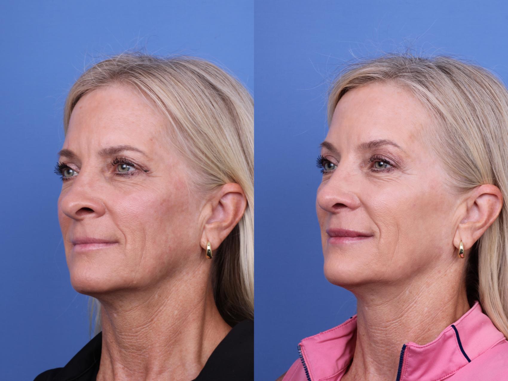 Before & After Rhinoplasty Case 713 Left Oblique View in Scottsdale, AZ