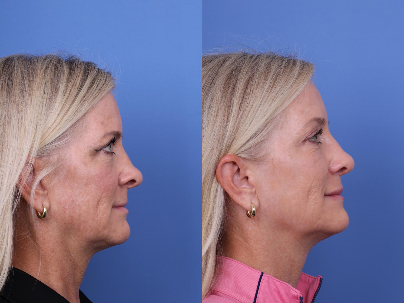 Before & After Rhinoplasty Case 713 Right Side View in Scottsdale, AZ