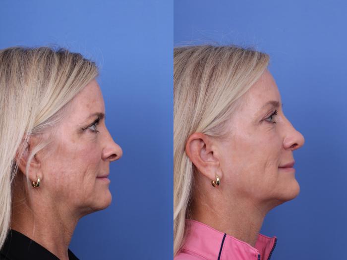 Before & After Rhinoplasty Case 713 Right Side View in Scottsdale, AZ