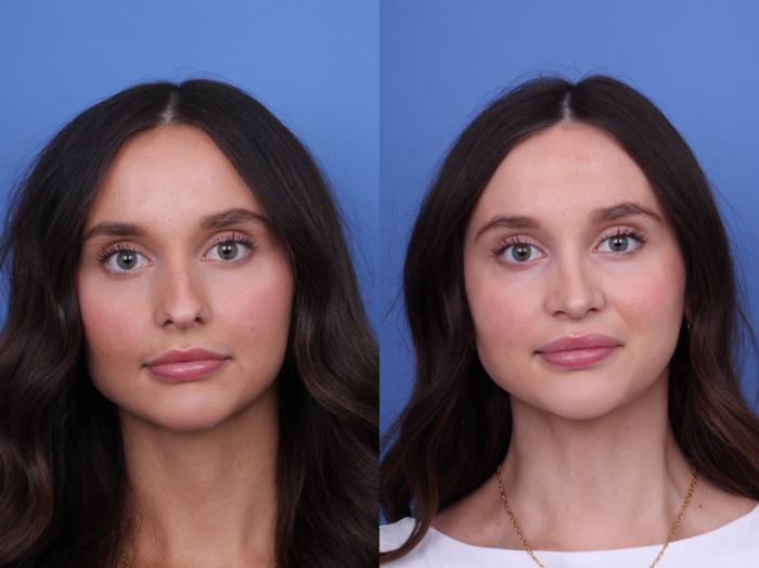 Before & After Rhinoplasty Case 724 Front View in Scottsdale, AZ
