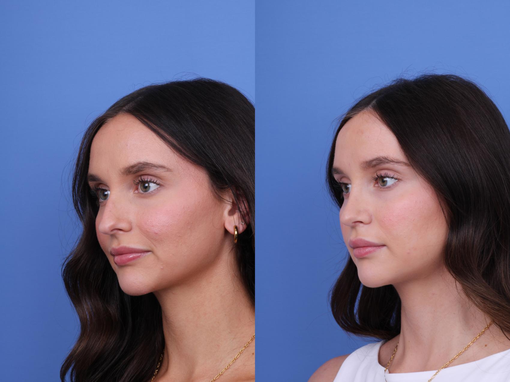 Before & After Rhinoplasty Case 724 Left Oblique View in Scottsdale, AZ