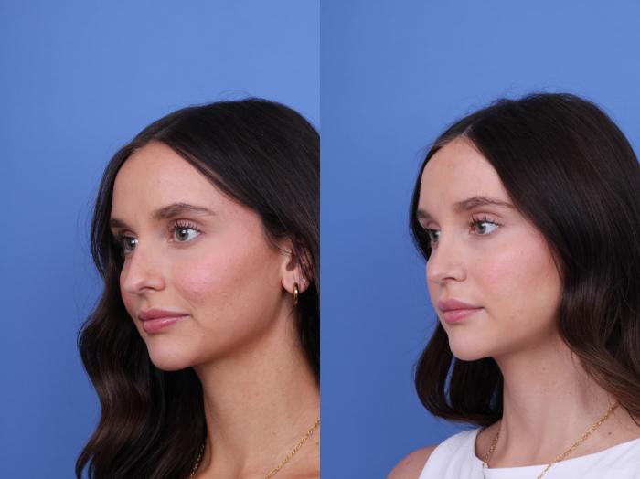 Before & After Rhinoplasty Case 724 Left Oblique View in Scottsdale, AZ
